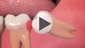 It does not matter how large or small your jaw bone is, if you have a wisdom tooth. Wisdom Tooth Extraction Wootton Bassett Cottage Dental And Implant Clinic