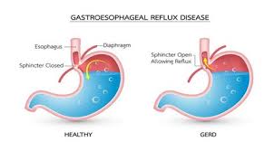 Penyakit gastritis mungkin timbul ketika kita mengalami stress. Gastritis Merupakan Panyakit Karena Gangguan Gastritis Merupakan Panyakit Karena Gangguan Obat Maag Gastritis Merupakan Penyakit Atau Gangguan Dimana Dinding Lambung Mengalami Peradangan
