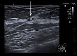 Full Text Adverse Reaction Regarding Titanium Based Marker Clip Case Report Of Imcrj