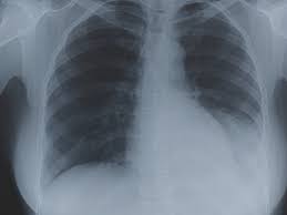 Chest X Ray To Check Fitness Is Outdated Health Gulf News