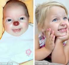 For two-year-old Connie Lloyd, there was nothing amusing about having a  bright red "clown's nose." Born with a benign tumor that grew to cover her  nose, she suffered cruel taunts and name-calling