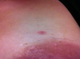 I have slight pink purplish blemishes. Inflammatory Breast Cancer India Pdf Ppt Case Reports Symptoms Treatment