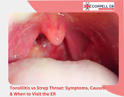 Image result for Tonsillitis