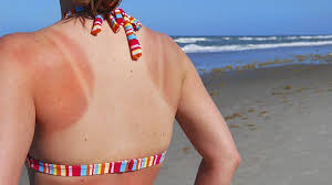 How long does a sunburn last? 5 Sunburn Treatments To Save Your Vacation Everyday Health