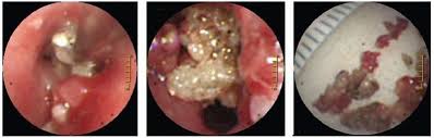 Image result for Broncholithiasis