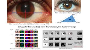Image result for Intraocular Pressure