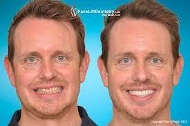 There are various effective exercises and face yoga which helps in fixing a crooked smile. Crooked Jawline Fix No Braces Clear Aligners Or Surgery