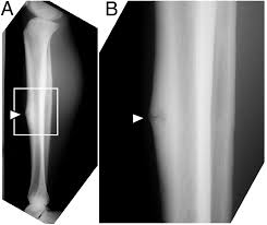 Image result for Tibia Stress Fracture