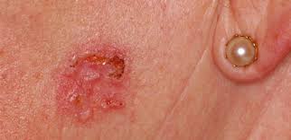 Ansikte, nacke, rygg och bröst är de mest typiska områdena för akne att utvecklas. Bilder Pa Hudsjukdomar Och Hudakommor Netdoktor