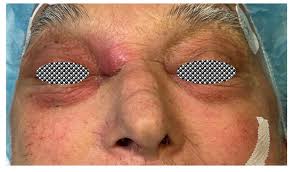 Image result for Sinusitis Prediction Rule