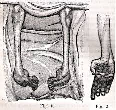 Hereditary Motor Sensory Neuropathies Charcot Marie Tooth
