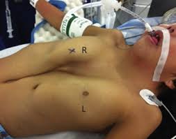 Formulary drug information for this topic. Z Type Pattern Pectus Excavatum Carinatum In A Case Of Noonan Syndrome The Annals Of Thoracic Surgery
