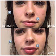 Juvederm ultra plus xc before and after. Voluma In Cheeks And Juvederm Ultra Plus Xc In Lips Adding Volume To The Face And Lips Can Make Such A Big Difference Voluma Juvederm Injectables Fillers
