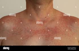 Image result for Photodermatitis