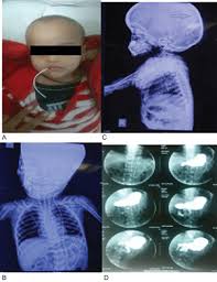 A Per Oral Extrusion Of Distal End Of Vp Shunt Tube B And C Download Scientific Diagram