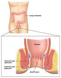 When to See a Gastroenterologist for an Anal Fissure - Gastro SB