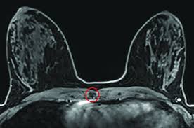 Image result for Incidental Imaging Finding