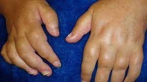 Swollen Hands: Exercise, Other Causes, And Treatment