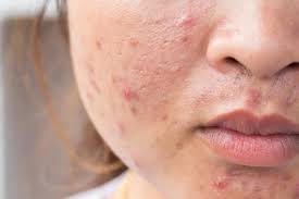 This can help keep the skin moist and reduce itching. Ofkrdfxszkazum