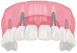 Image result for dental implant