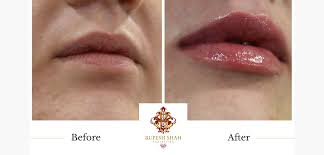 In a recent beauty department meeting, we discovered some pretty awesome lipsticks—not only are. Lip Fillers London Lip Injections Lip Augmentation Rupesh Shah Aesthetics