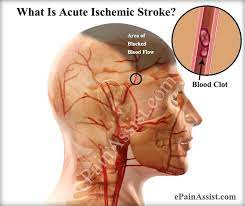 However, it does not always entail the parallel decline of motor function. Acute Ischemic Stroke Causes Symptoms Treatment Anticoagulants Corticosteroids