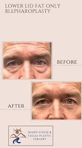 Transformation Tuesday. Comprehensive care, natural results. To schedule  call 208.344.3220 or reach out through our webpage.  www.idahoeyelidandface.com, #boiseplasticsurgery #eyelidlift , #facelift ...