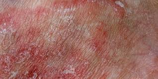 Image result for Erythrasma