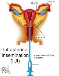 Pin On Infertility