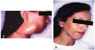 Paracoccidioidomycosis: Current Perspectives from Brazil