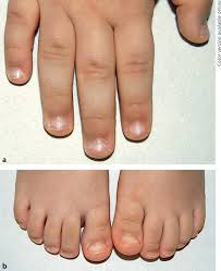 Image result for Koilonychia feet