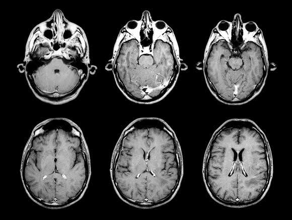 Lights Out: A New Reckoning for Brain Death | The New Yorker