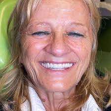 Estetska korekcija nosa