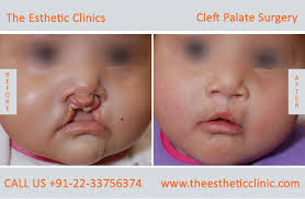 Technical areas of the cleft lip revision include adjusting the rotation advancement, enhancing the upper lip line (m design/or called cupid's bow), and addressing any imbalances in. Best Cleft Palate Treatment In Mumbai India Cleft Nose Surgeon The Esthetic Clinics