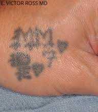 8 reviews of oregon aesthetics i've been coming to oregon aesthetics for a while now and let me tell you, this is where to get your tattoo removed for sure . Enlighten Laser Tattoo Removal Portland Oregon Bridgetown Aesthetics