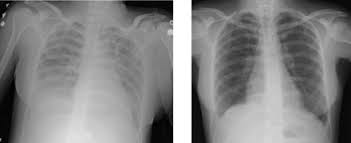 The authors of this review discuss our current understan. Acute Respiratory Distress Syndrome Wikipedia