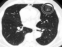 A radiologist, a physician who specializes in reading and interpreting ct scan and other radiologic images, will review your scan and prepare a report that explains them. Diagnostic Accuracy Of North America Expert Consensus Statement On Reporting Ct Findings In Patients Suspected Of Having Covid 19 Infection An Italian Single Center Experience Radiology Cardiothoracic Imaging