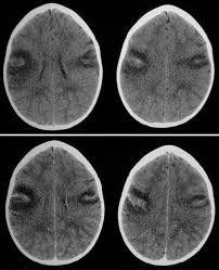 Typical mri features of herpes simplex encephalitis. Radiology In Ped Emerg Med Vol 7 Case 9