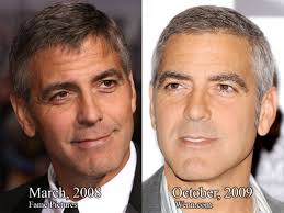 George Clooney Plastic Surgery Before After Always Interesting What You Can Find When You Type In Co Plastic Surgery Cosmetic Surgery Celebrity Plastic Surgery