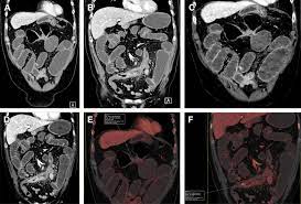 Practical Applications Of Dual Energy Computed Tomography In The Acute Abdomen Radiologic Clinics