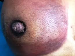 Image result for Inflammatory breast cancer