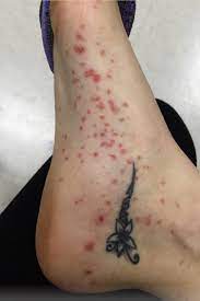 La actriz daniela nicolás, a través de instagram, se refirió a una delicada enfermedad que padece, lo cual acompañó de fotografías. Daniela Nicolas Mostro Como Queda Su Piel Debido A La Enfermedad Autoinmune Que Sufre