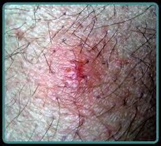 Bird Mites In Human Hair Bird Mite Dermatitis Check Out Http Www Wtgpestcontrol Com Bird Mites To Find Out More About Bird Mites Mites How To Find Out Infestations