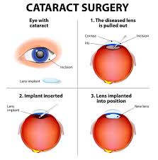 cataract