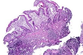 Image result for Intestinal Enteropathy
