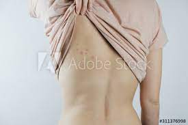 See more ideas about character art, character design, female images. Damaged Skin On Female S Back Bedbug Bites Moosquito Bites Or Skin Disease On Human Body Buy This Stock Photo And Explore Similar Images At Adobe Stock Adobe Stock
