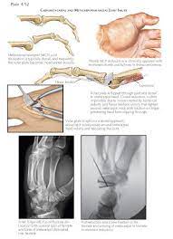 Carpometacarpal And Metacarpophalangeal Injuries Other Than Fracture Musculoskeletal System Fracture Injury