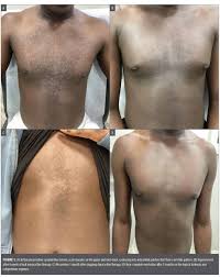 Image result for Calcipotriene