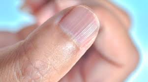 أسباب تموج الأظافر - ويب طب