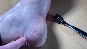 We recommend dry skin as it gives you more control over how much you shave off. Remos Callus Shaver Stainless Steel Unboxing And Instructions Youtube